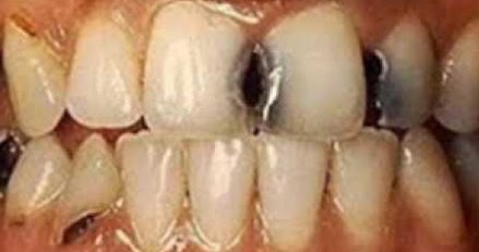 88 Arti Mimpi Gigi Keropos Copot Semua Patah Dan Tanggal Pertanda Mimpi Gigi