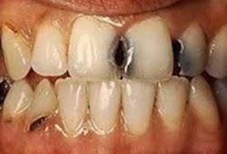 88 Arti Mimpi Gigi Keropos Copot Semua Patah Dan Tanggal Pertanda Mimpi Gigi