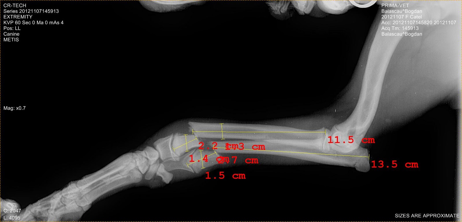 fractura veche de os scafoid