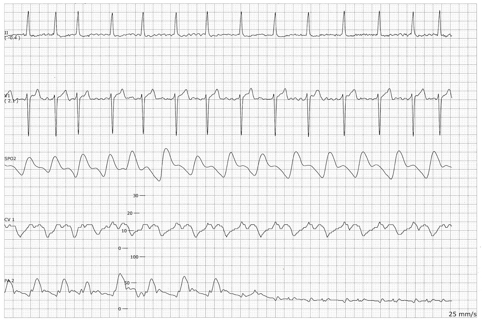Pulmonary Artery Wedge Pressure Meaning Bullhome pulmonary-artery-wedge-pressure-meaning-bullhome