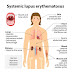 Systemic lupus erythematosis (SLE): Etiology and pathogenesis