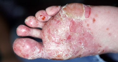 El tratamiento de la psoriasis por el hígado