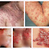Tips dan cara mengobati kulit melepuh berisi cairan | Obat Herpes