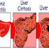 Harga Obat penyakit liver dan empedu thumbnail