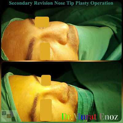 revision tipplasty in İstanbul,revision tipplasty in Turkey,revision tip plasty,revision tip plasty operation in Istanbul,Nose tip plasty,open technique tip plasty,