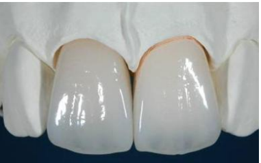 Tìm hiểu quy trình bọc răng sứ thẩm mỹ Lam-rang-su-gia-bao-nhieu-tien