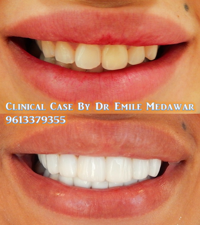 Veneer Hollywood Smile, Dr Emile Medawar, 00961 3 379355 2015
