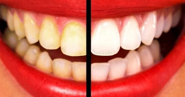 How To Whiten Your Yellow Teeth In Less Than 2 Minutes. It Really Works !