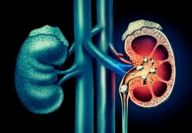 Health news of the week: Kidney stones; types, symptoms, diagnosis, more.