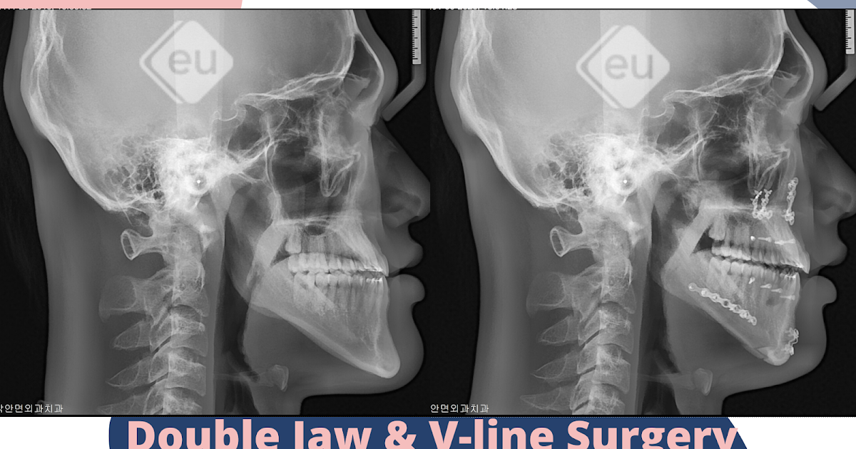 How to improve lantern jaw through double jaw surgery.