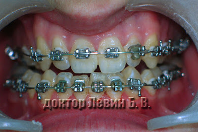 Врачебная ошибка неверное приклеивание брекетов