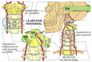 La Arteria vertebral.