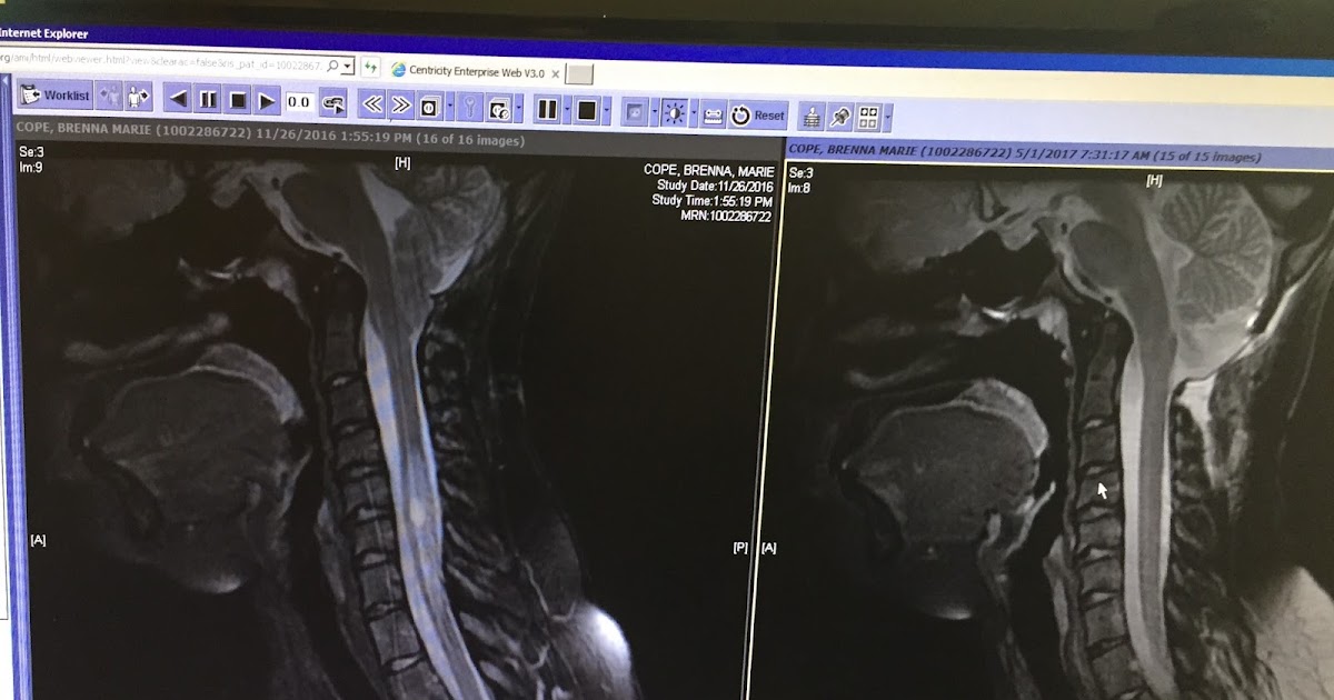 My Journey with Chiari Malformation : CLEAR MRI & 1 Year Anniversary of ...