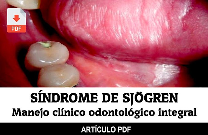 PDF: SÍNDROME DE SJÖGREN, Manejo clínico odontológico integral 