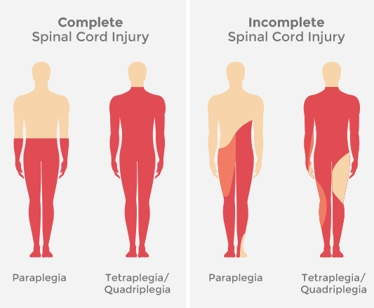 Spinal Cord Injury