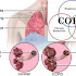 Nursing Assessment - NCP for COPD