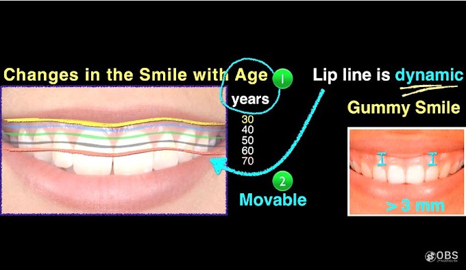 GUMMY SMILE Treatment - Clinical Case of Dr. Chris Chang