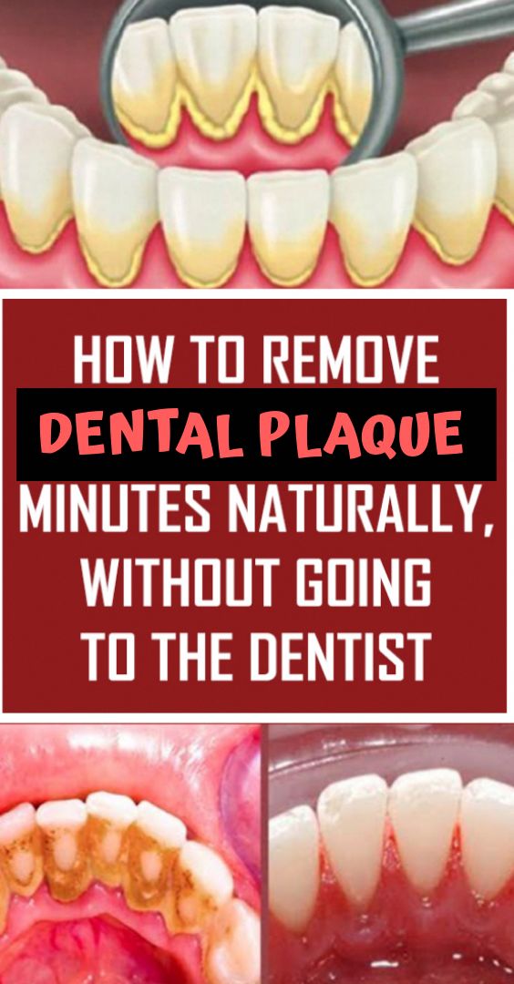 How to Remove Dental Plaque in 5 Minutes Naturally, without Going to