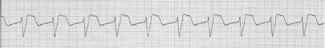 accelerated idioventricular rhythm