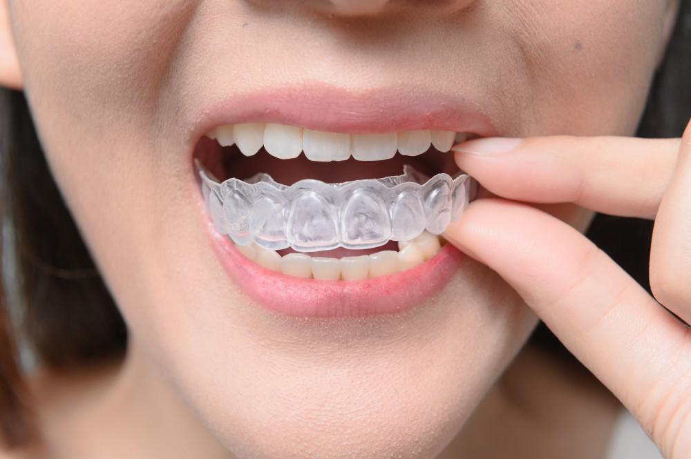 Should You Get Clear Aligners?