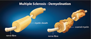 Myelin Multiple Sclerosis
