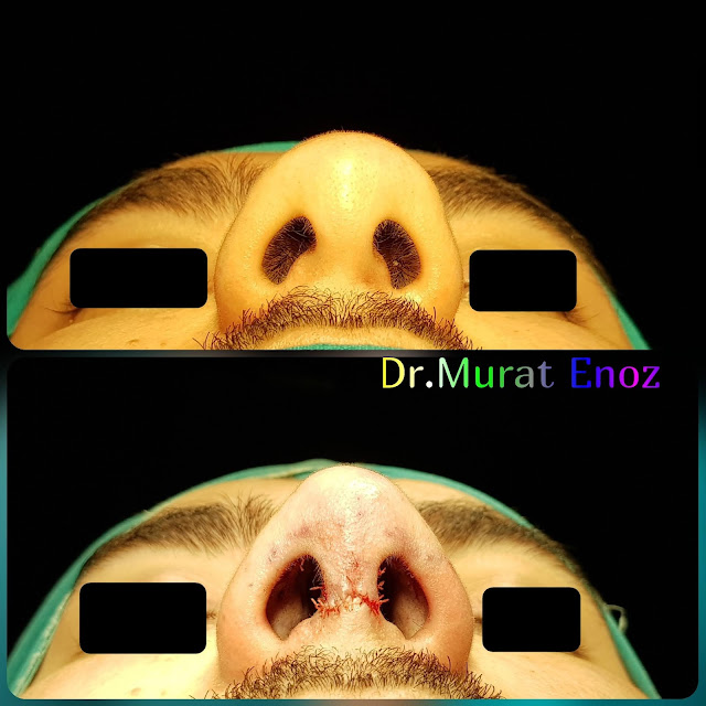 Rhinoplasty in men Istanbul, Male nose job Turkey. Nose aesthetic surgery for men