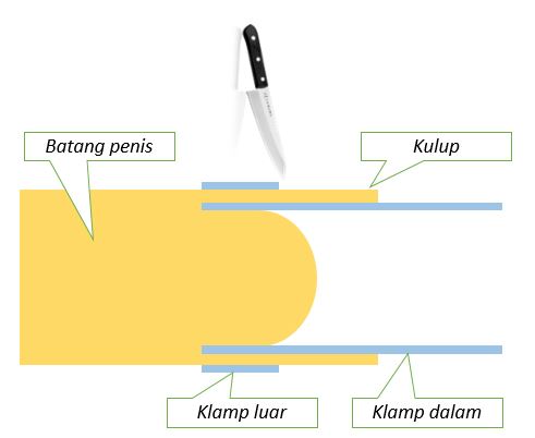 Cara Penjagaan Sunat Klamp Sunat Dewasa Metode Stapler Pusat Khitan