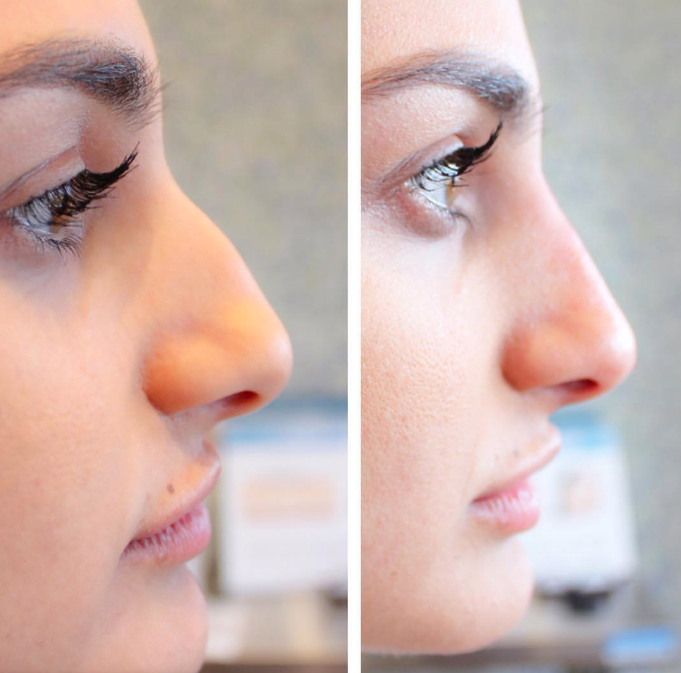 Best Nose Fillers (Non Surgical Nose Job) Singapore Price and Reviews 2023