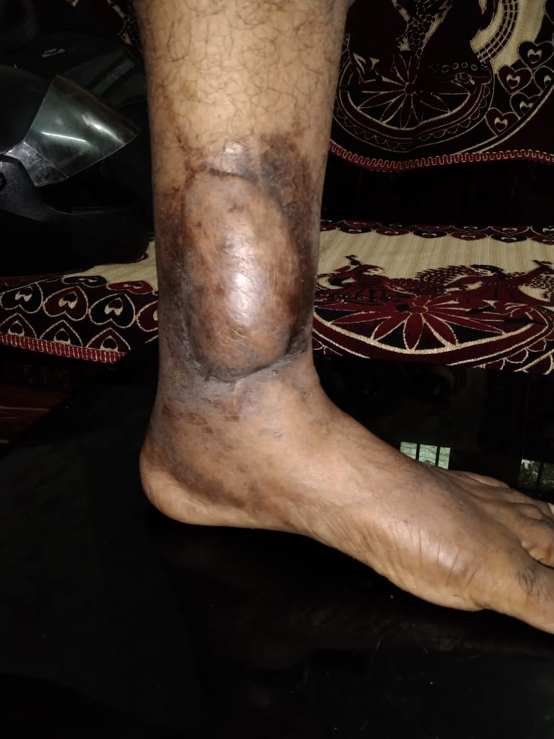 POST OPERATIVE CHRONIC OSTEOMYLELITIS SEQUESTRECTOMY AND FREE