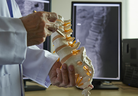 Penyakit Hiperlordosis Pada Kasus Muskuloskeletal  Hiperlorsis merupakan sebuah kondisi yang mempengaruhi keadaan dari postur tubuh manusia. Sehingga melalui gangguan ini manusia akan terasa sulit untuk melakukan aktivitasnya dengan baik. Maka dari itu artikel ini akan membahas mengenai penyakit hiperkifosis pada manusia, untuk mengetahuinya dengan lebih lanjut silahkan di simak dengan sebagai berikut ini :  Definisi Hiperlordosis  Hiperlordosis merupakan gangguan tulang belakang pada punggung bawah yang memiliki kelengkungan berlebihan (Faiz, 2002). Hiperlordosis merupakan lengkungan alami pada punggung bawah atau pada daerah lumbal melengkung melebihi normal sehingga menyebabkan tekanan berlebihan (Naidoo, 2008).  Etiologi Hiperlordosis  Etiologi yang ditemukan pada kondisi ini adalah sebagai berikut : Pada masa kehamilan wanita sering cenderung membungkuk kedepan akibat dari menopang bayi Sikap tubuh yang buruk sejak dini, pembentukan tulang punggung yang kurang sempurna  Faktor Risiko Hiperlordosis  Faktor risiko yang ditemukan pada kondisi ini adalah sebagai berikut : Posisi tubuh, alas kaki (cenderung wanita menggunakan heels) Postur tubuh yang buruk, obesitas  Manifestasi Klinis Hiperlordosis  Manifestasi klinis yang ditemukan pada kondisi ini adalah sebagai berikut : Rasa nyeri Spasme otot   Nah itu dia bahasan dari penyakit hiperlordosis pada kasus muskuloskeletal. Dari bahasan di atas bisa diketahui mengenai definisi, etiologi, faktor risiko, dan manifestasi klinis dari kondisi ini. Mungkin hanya itu yang bisa disampaikan di dalam artikel ini, mohon maaf bila terjadi kesalahan di dalam penulisan, terimakasih telah membaca artikel ini."God Bless and Protect Us"