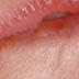 What Are The Causes Of Angular Cheilitis?