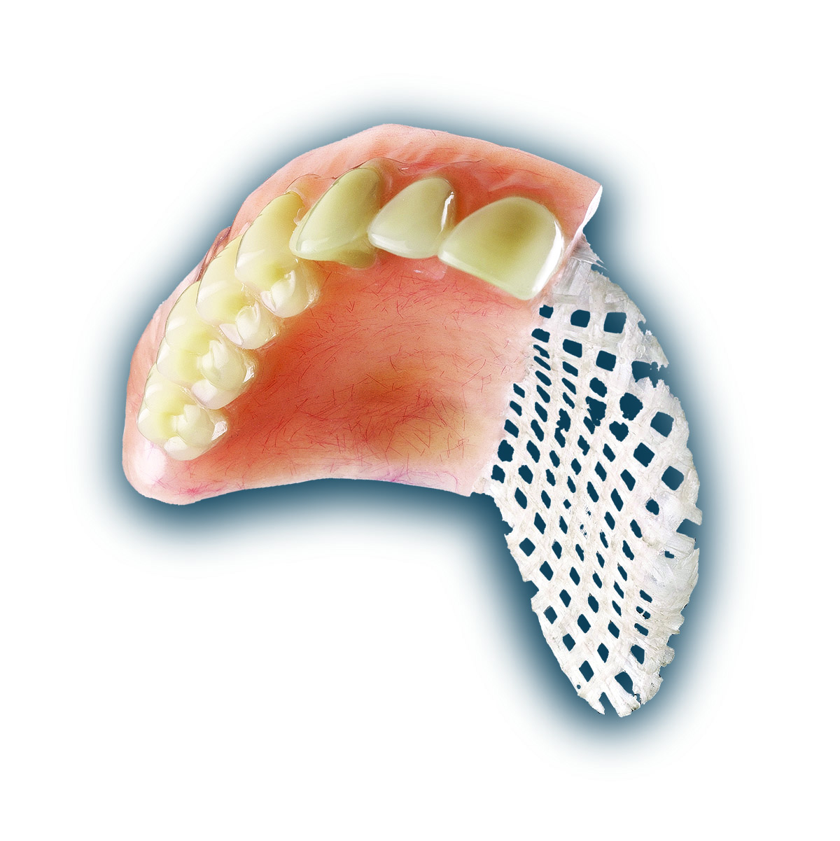 News Room ROE Dental Laboratory A New Rigid Reinforcement Material