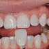 Bọc răng sứ titan hiệu quả trong trường hợp nào? 