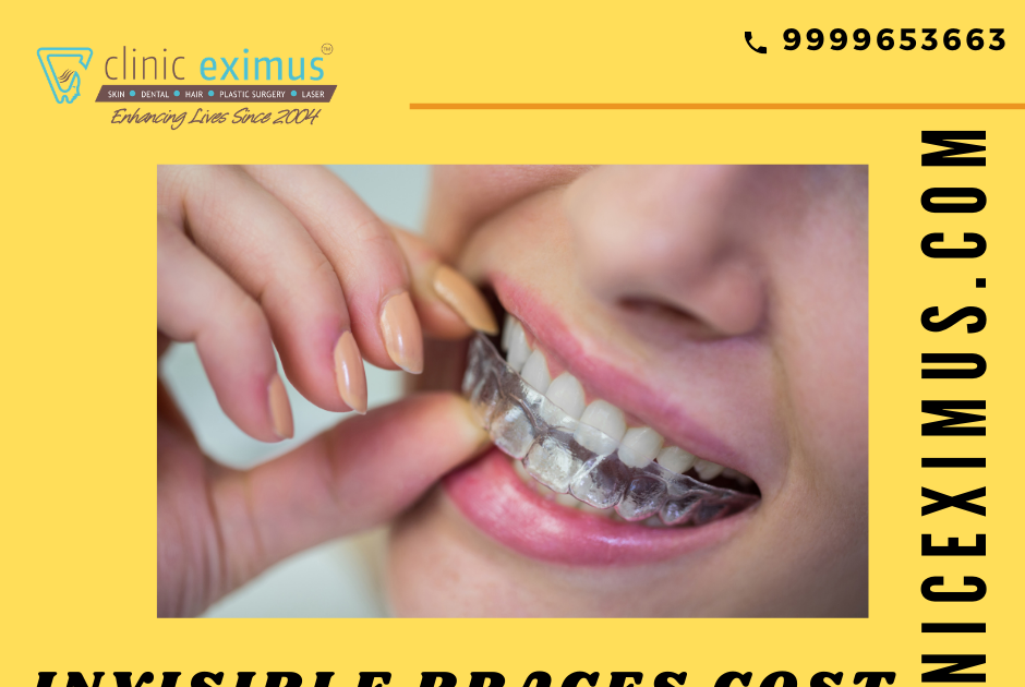 least expensive invisible braces least expensive invisible braces