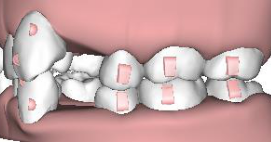 \ud83d\udcd5 \u745e\u5fb7\u7f8e\u7259\u91ab | \u77e5\u8b58\u5c08\u6b04\u6587\u7ae0: \ud83d\udcac\ufe5d\u4e0b\ufe5e\u6578\u4f4d\u96b1\u5f62\u77ef\u6b63\u7259\u5957\u7cfb\u7d71\u7684\u5206\u5225