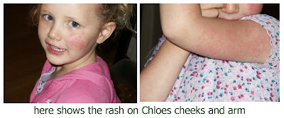 slap cheek, red rash on face children with red blodges, red hives arms body