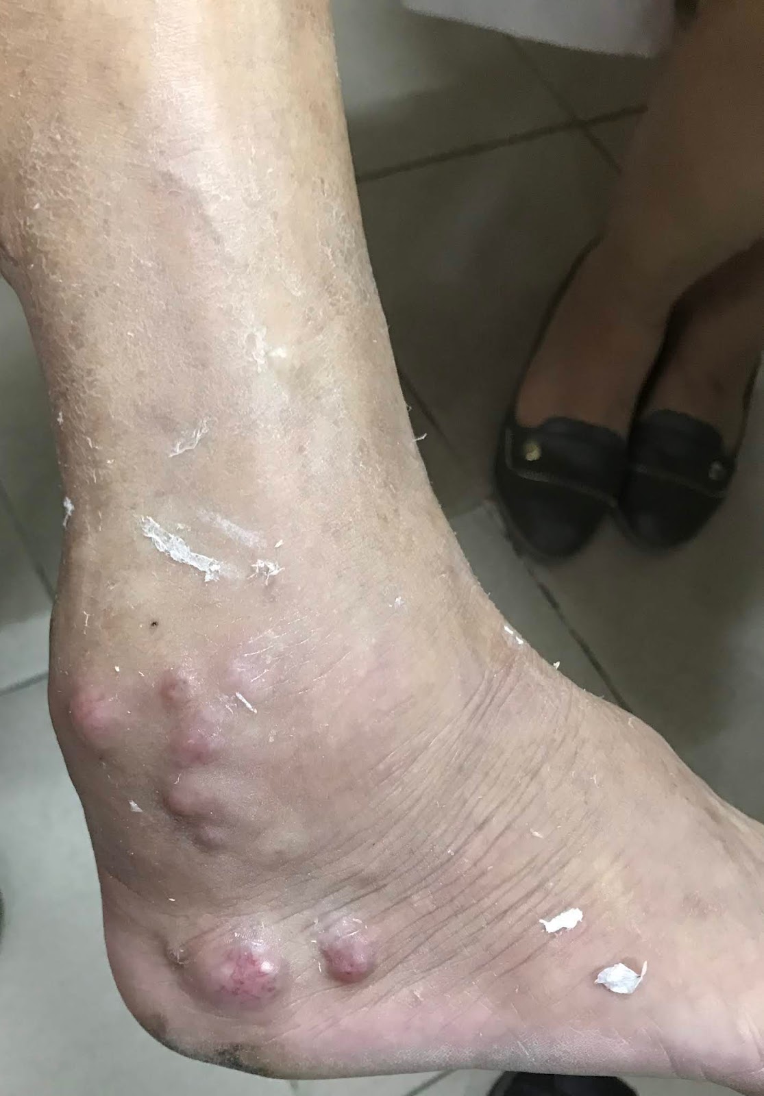 VIETNAMESE MEDIC ULTRASOUND CASE 557 LEG TUMOR, Dr PHAN THANH HAI