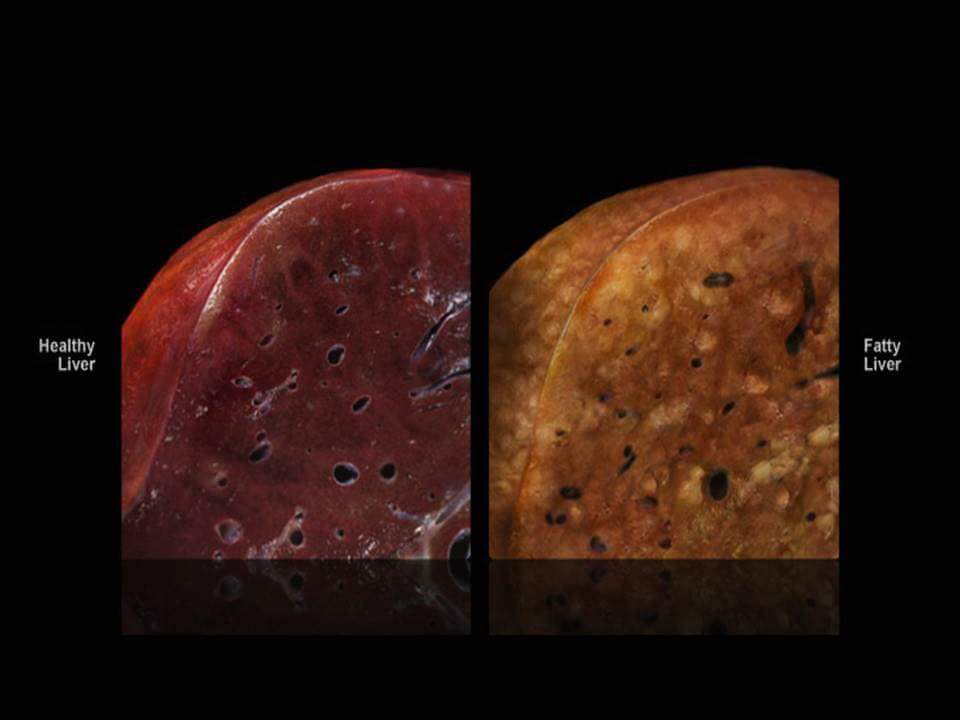 about billson Fwd Visceral Fat (VFat)