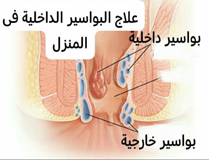 ما هي أعراض البواسير الخارجية عند النساء Thibaupsy الاب