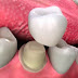 Ưu điểm của bọc răng sứ là gì ?