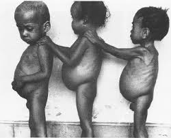 HERBAL/NATURAL REMEDY FOR TREATING KWASHIORKOR HERBAL/NATURAL REMEDY FOR TREATING KWASHIORKOR