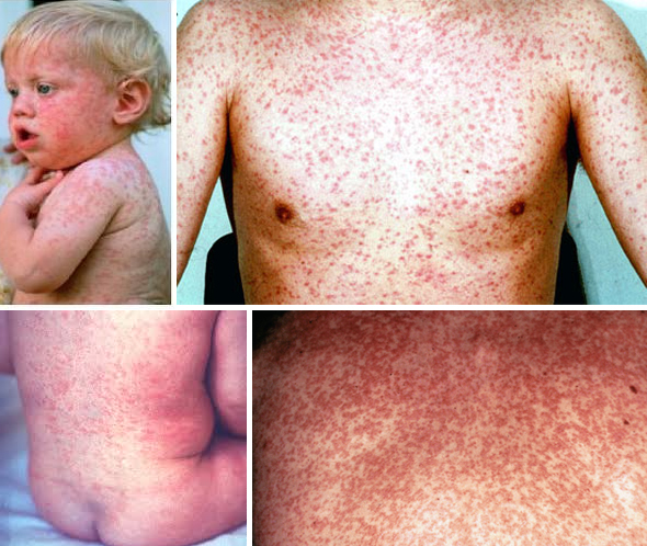 Obat Campak Secara Tradisional yang Mujarab ~ Obat Herbal Terampuh