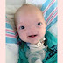 ‘miracle Baby’ Born Without A Nose Dies Aged Two