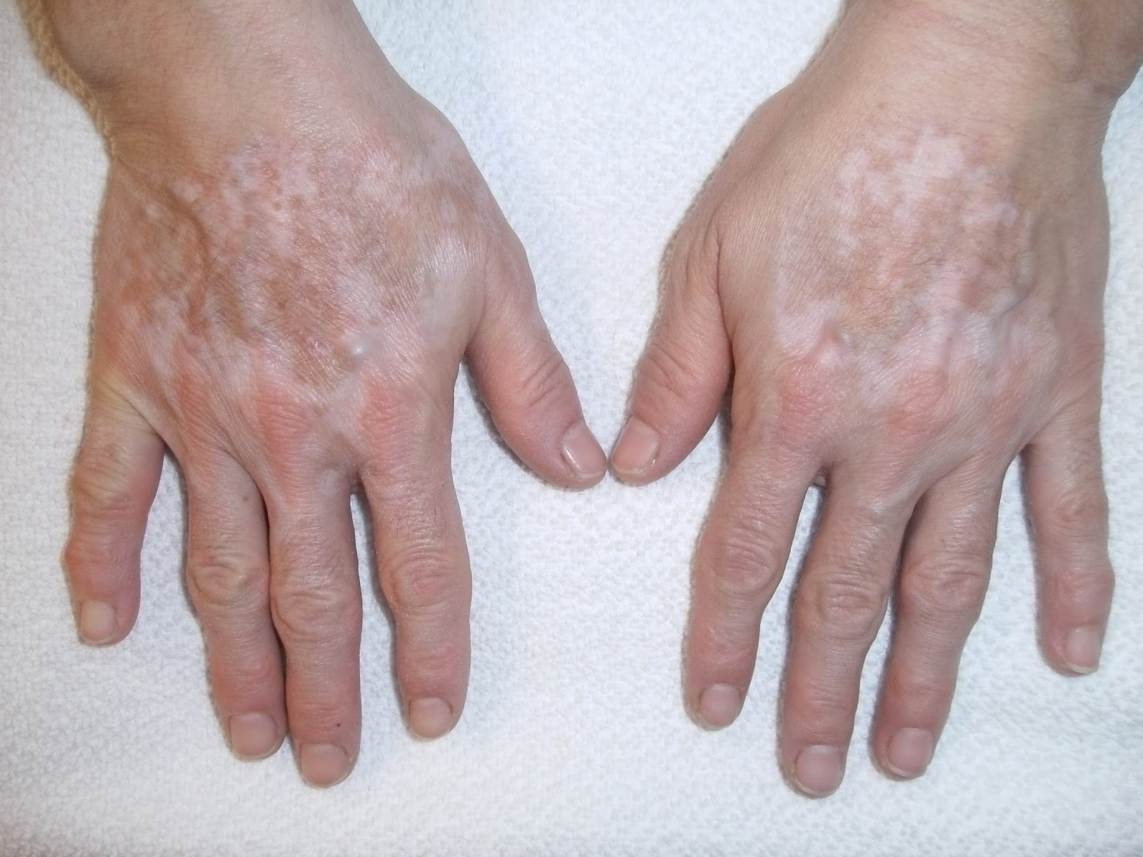 Rheumatologe Vitiligo in a Patient with Rheumatoid Arthritis under Methotrexate