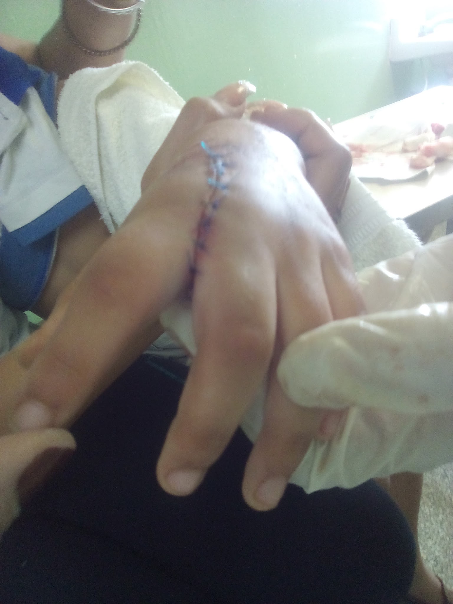 Sutura de herida de mano