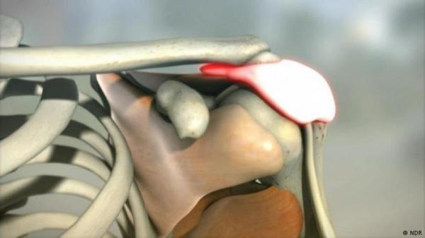 آلام الكتف - أسبابها وكيف يمكن التخلص منها؟ 