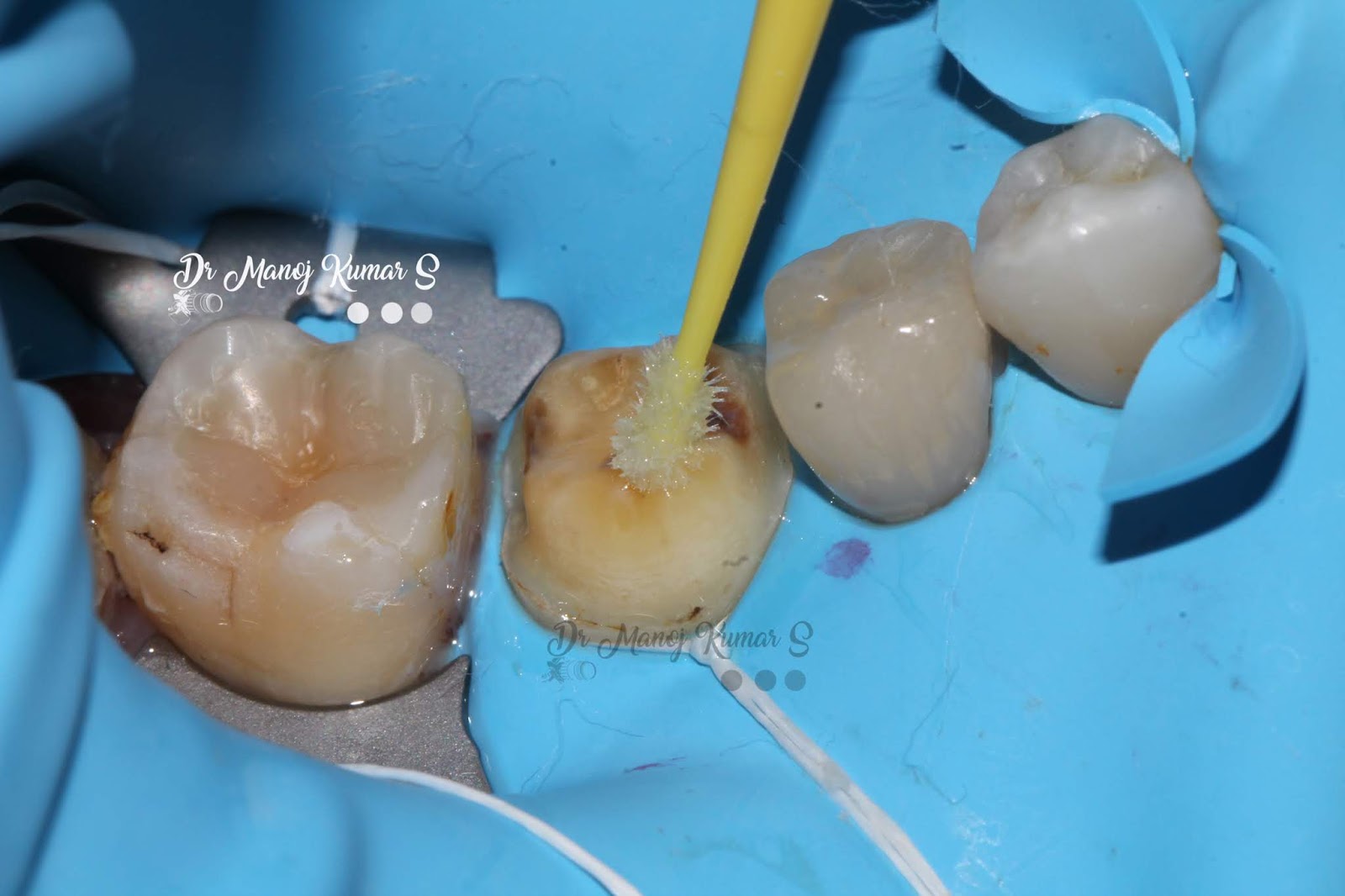 Case 45 Cementation protocol for an emax lithium disilicate crown