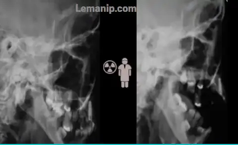 Anatomie De L'articulation temporomandibulaire (ATM)