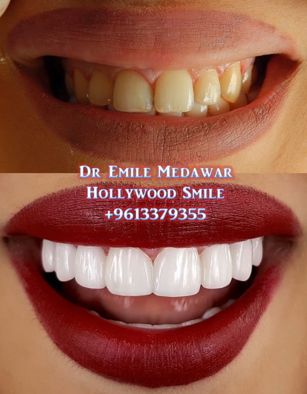 Porcelain Veneers, EMax Veneers, Direct Composite Veneers, Dental