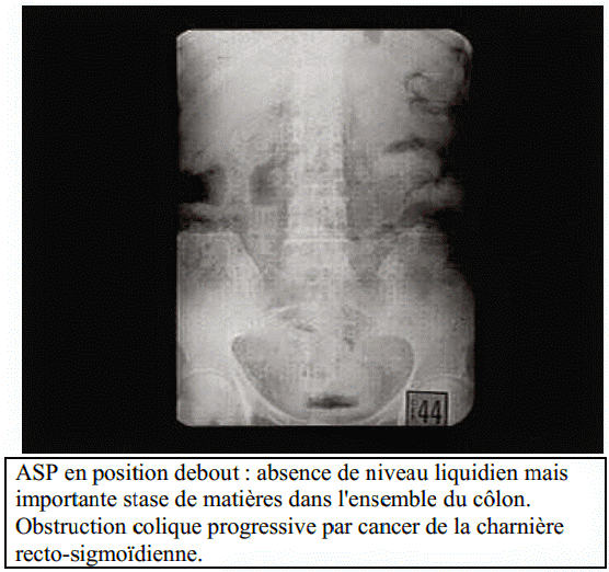 Fausse Envie D'aller à La Selle Colon Irritable Cours PDF | Cancer colorectale Causes, Diagnostic, Traitement via